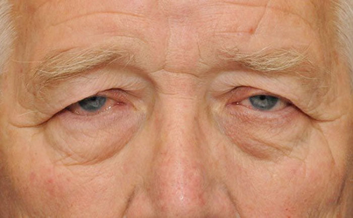 Suy giảm thị lực ở nam giới do lão hóa mắt tăng cao