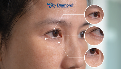Treo mày giúp khắc phục các lão hóa của vùng mắt như sụp mí, vết chân chim