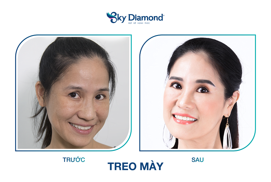 Hinh 3 Treo may Sky Diamond